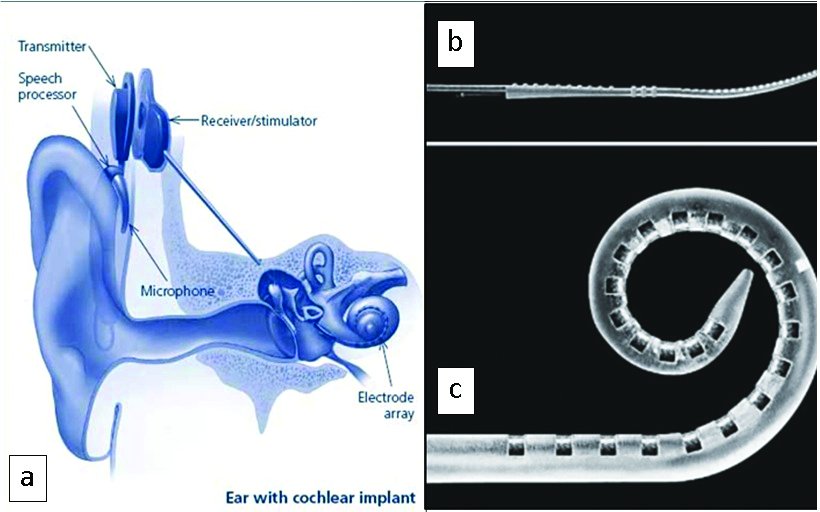 The Potential Use of Curved Nitinol Stylets for Optimized Robotic Insertion of Perimodiolar